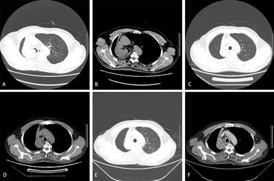 Self-Expandable Metallic Stent Implantation Combined With Bronchial Artery Infusion Chemoembolization in the Treatment of Lung Cancer With Complete Atelectasis